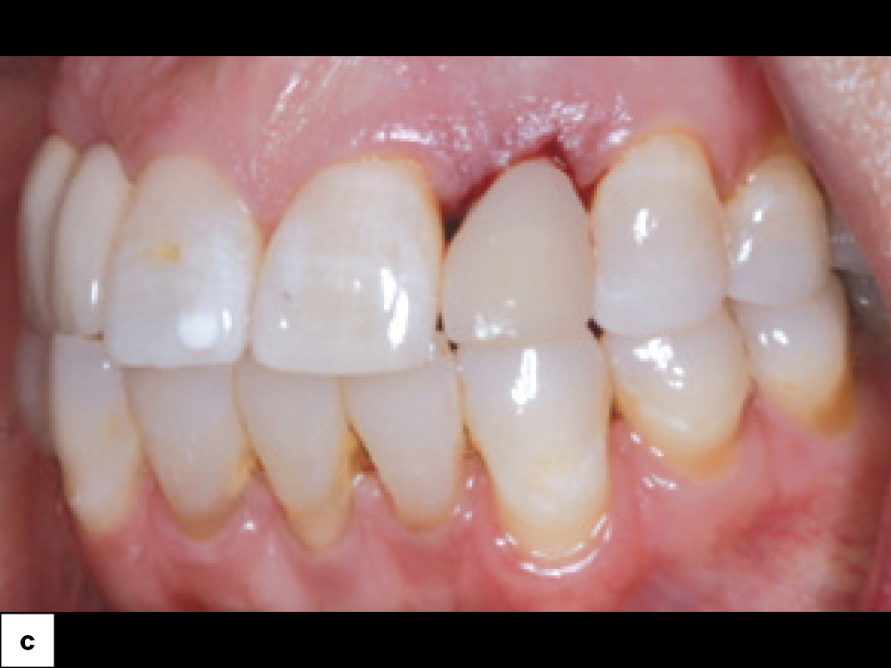 Temporary Crown Provisionalization