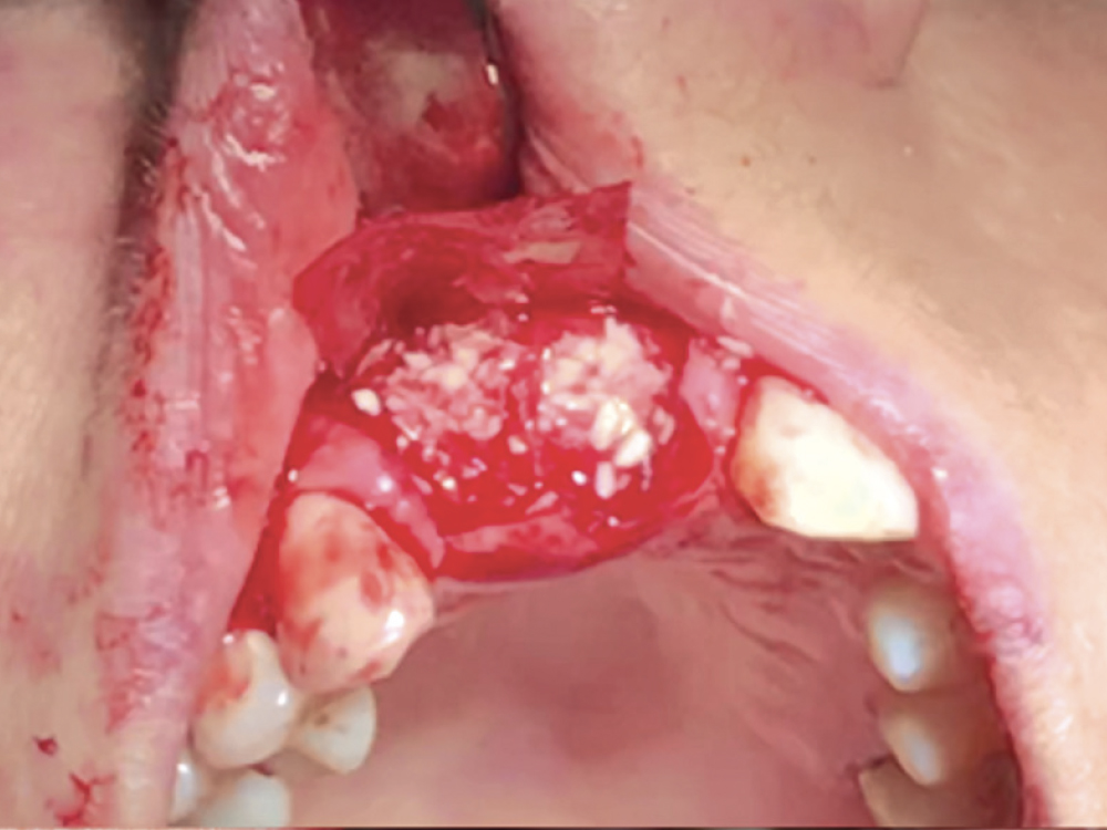 Implant Freehand Placement