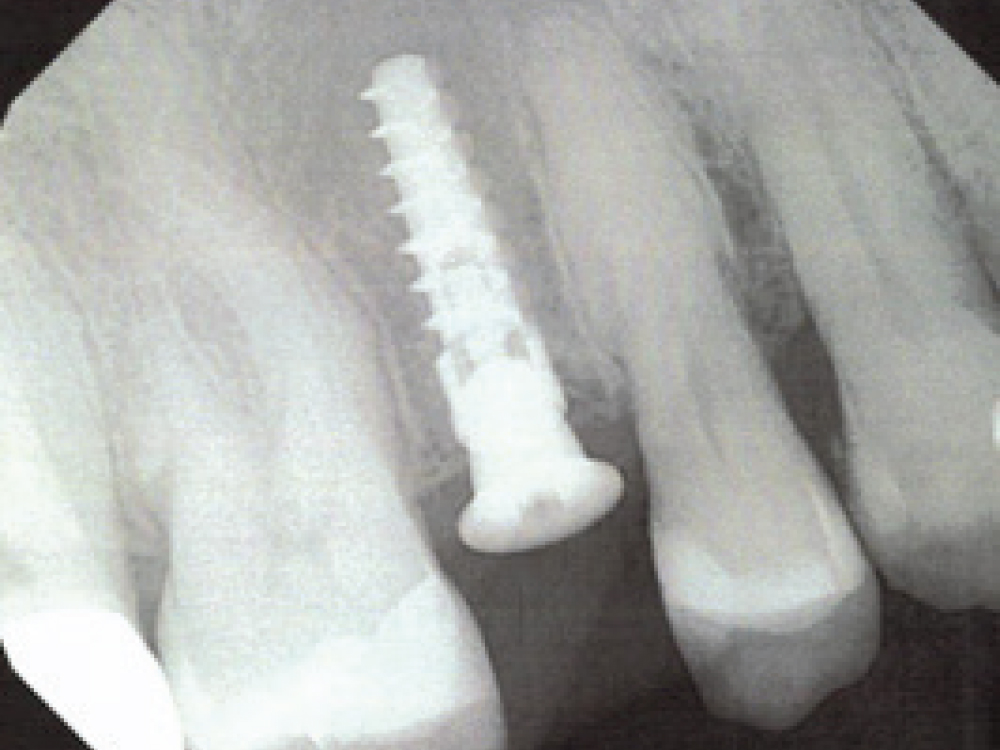 Extraction Site by Fenestration Case Pt3