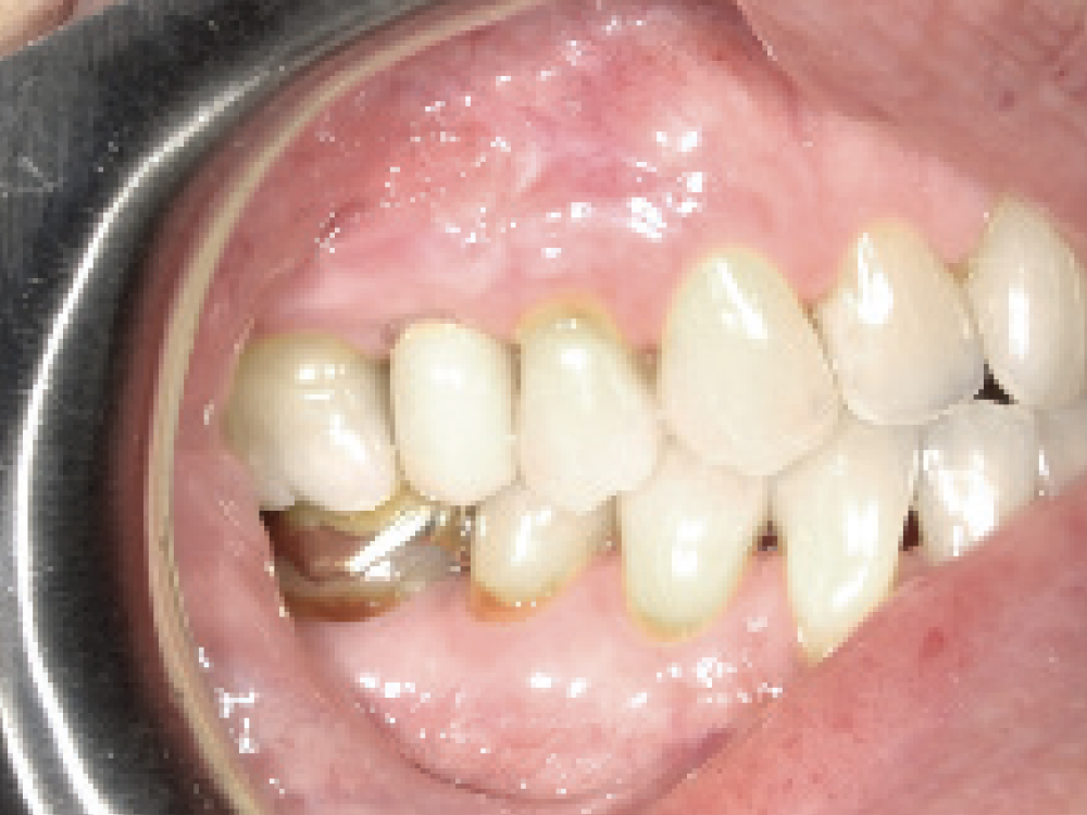 Extraction Site by Fenestration Cast Pt5