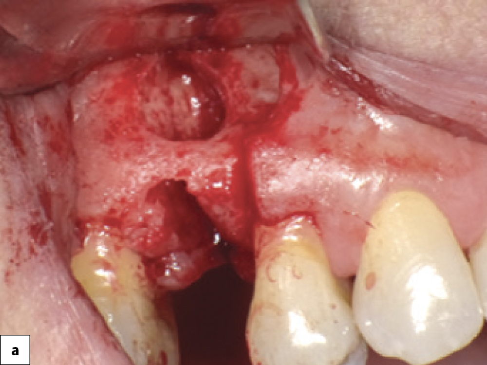 Bony Defect Evaluation A 