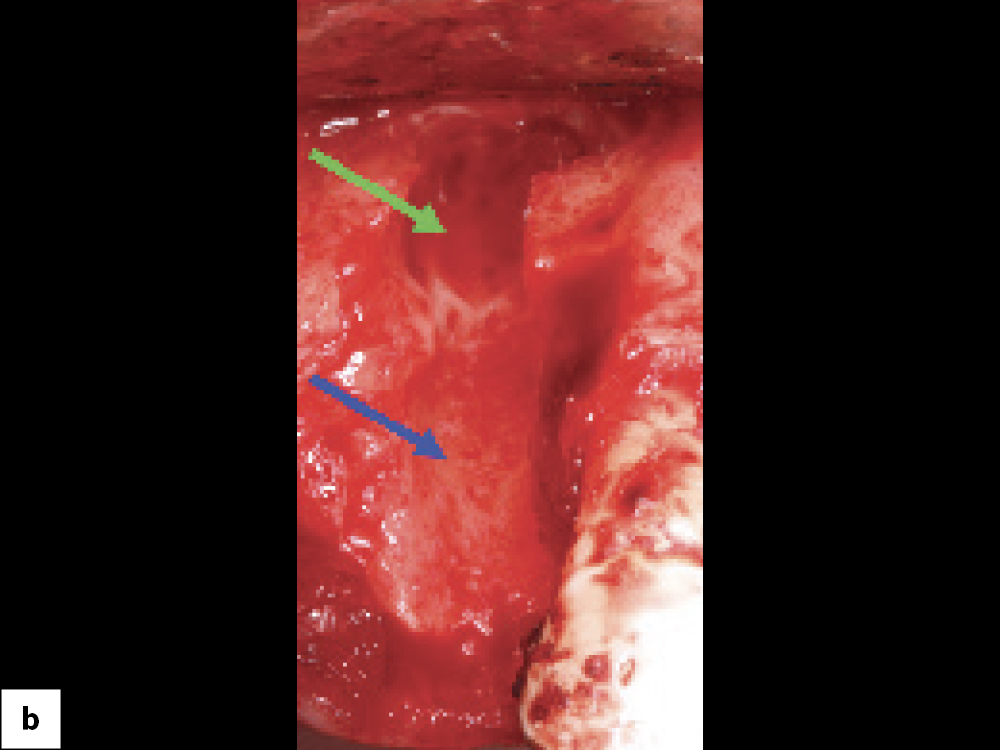 Bony Defect Evaluation B