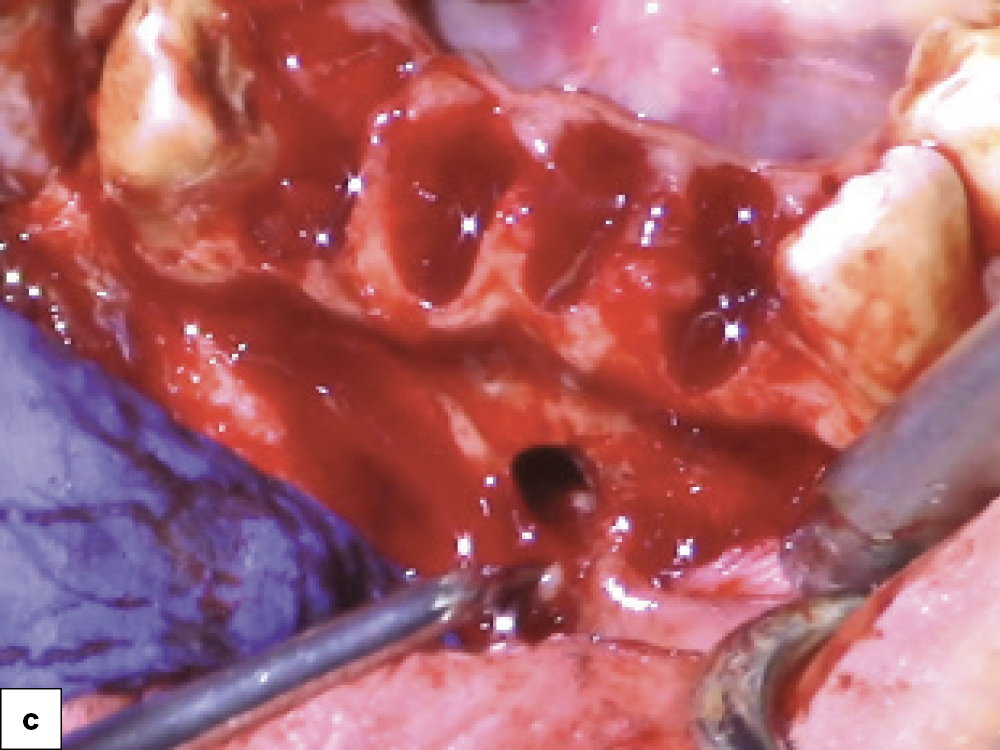 Bony Defect Evaluation C