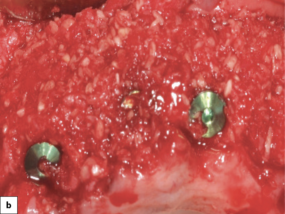 Newport Biologics Allograft Placement