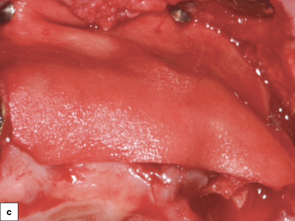 Newport Biologics Collagen for Containment