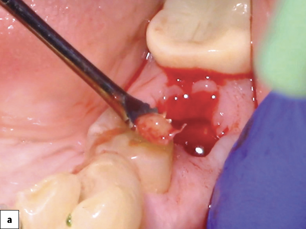 Socket Debridement A Tissue Removed