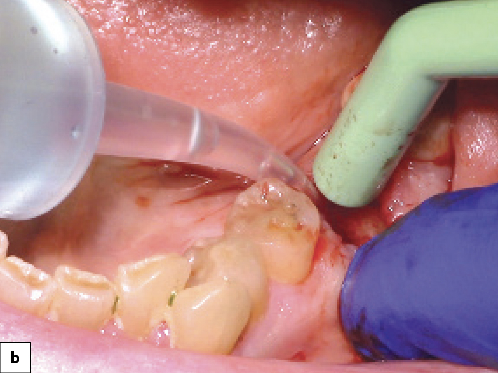 Socket Debridement B Sterilize Socket