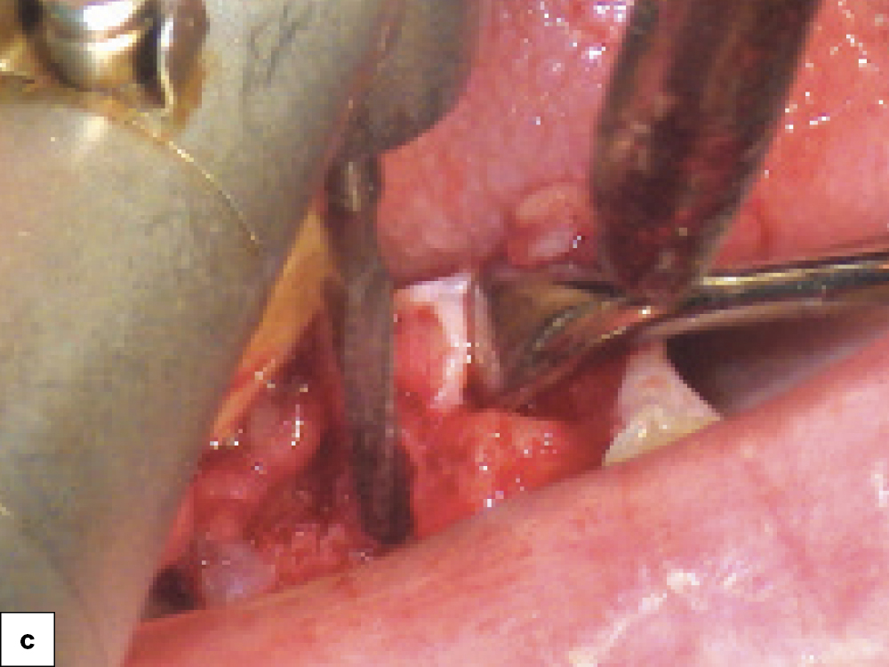 Socket Debridement C Stimulate Bone Growth