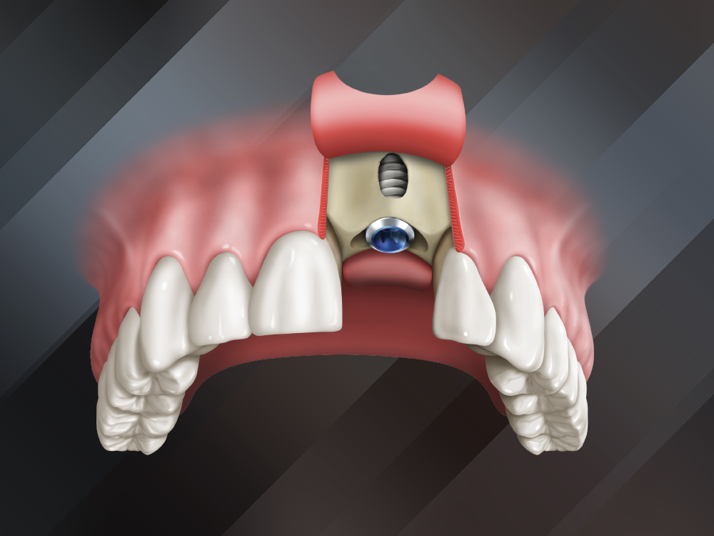 7 Steps for Treating Fenestrations with Rebecca Sheehan Hero Image CSMV16I2