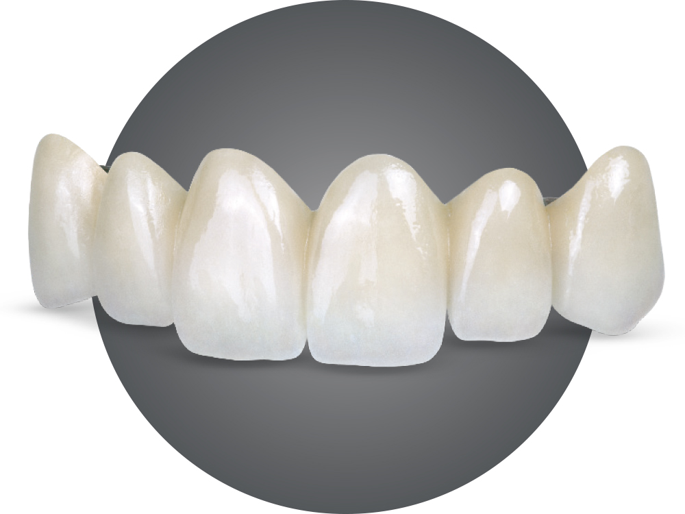 Porcelain fused to white high noble restoration per-unit price