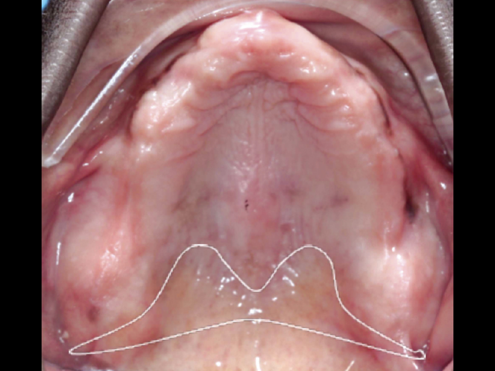 Outlined in white, the posterior palatal seal