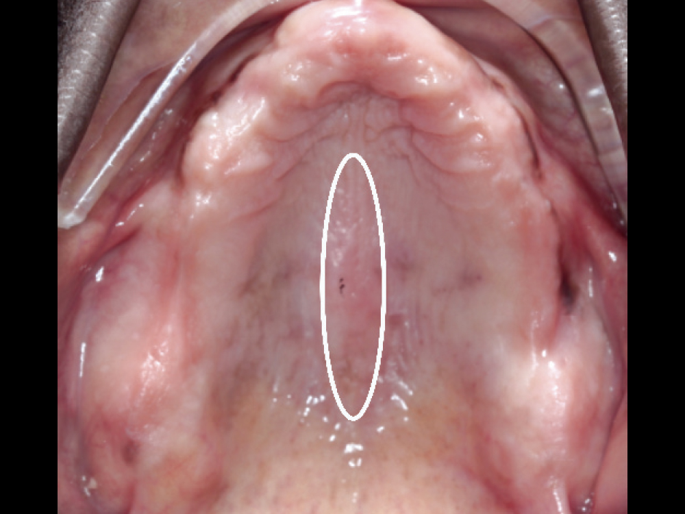 Outlined in white, denture extending too far into the median palatine suture