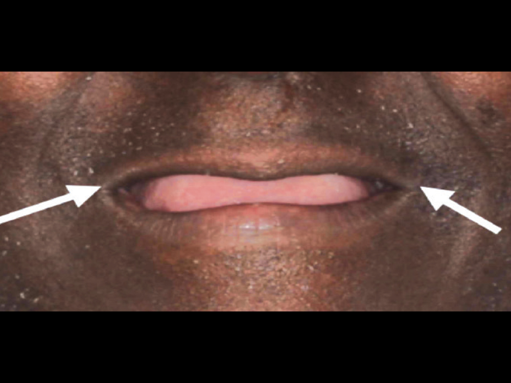 Commissures of the lips as guide for occlusal plane level 