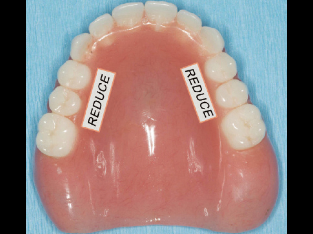 Reduce to free up tongue space depending on patient's phonetics check