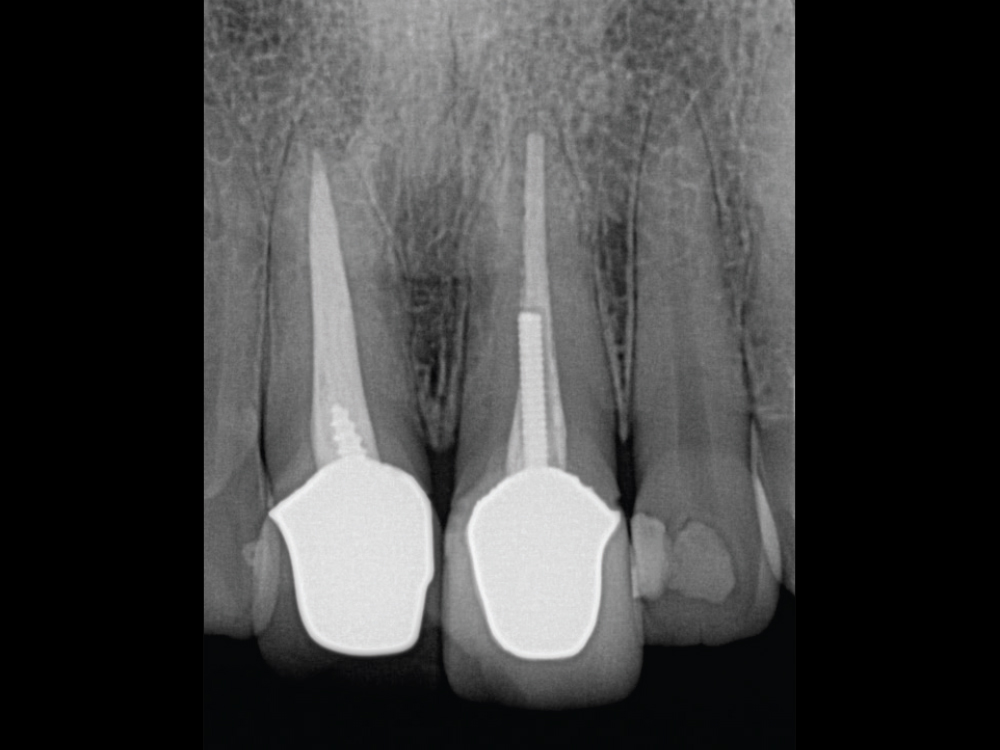Teeth needing extraction