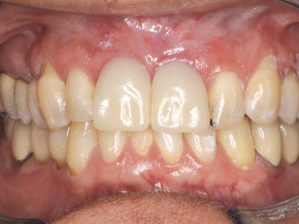 Fixed teeth in a day