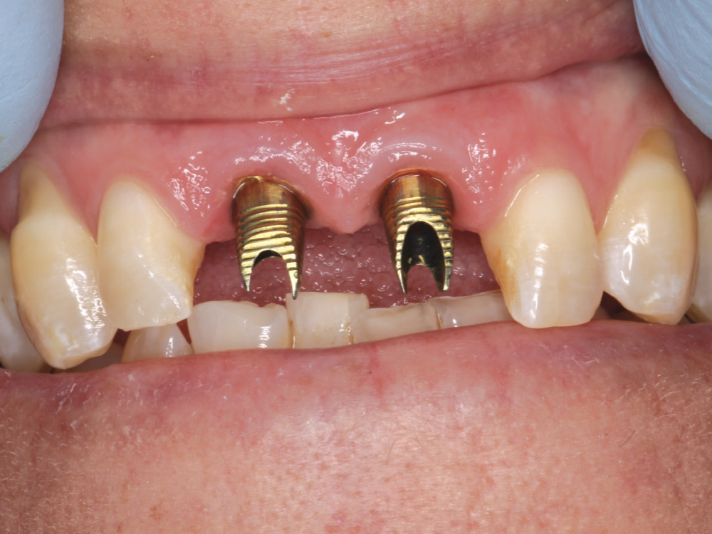 Gold-tone custom abutments
