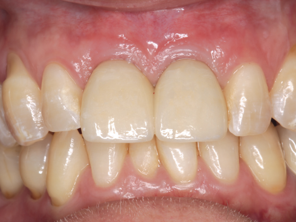 Life-like esthetic restorations