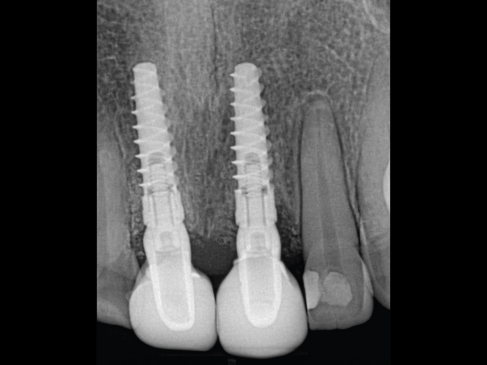 Scanner view of abutments