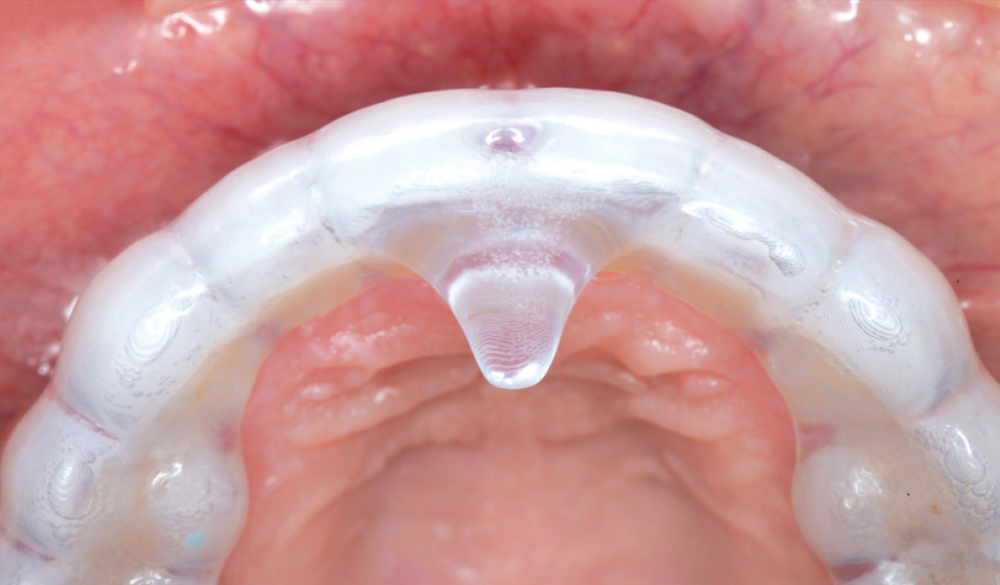 NTI OmniSplint Maxillary - CSMV16I2