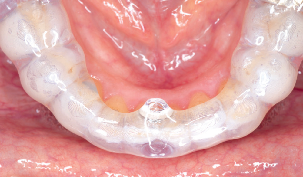 NTI OmniSplint Mandibular - CSMV16I2
