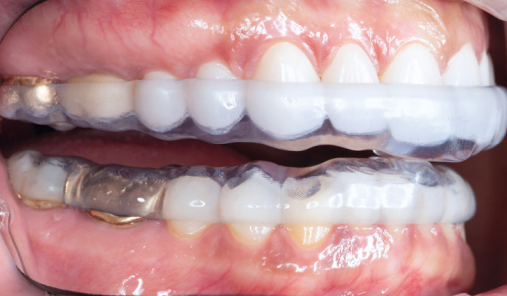 Patient wearing NTI OmniSplint - CSMV16I2