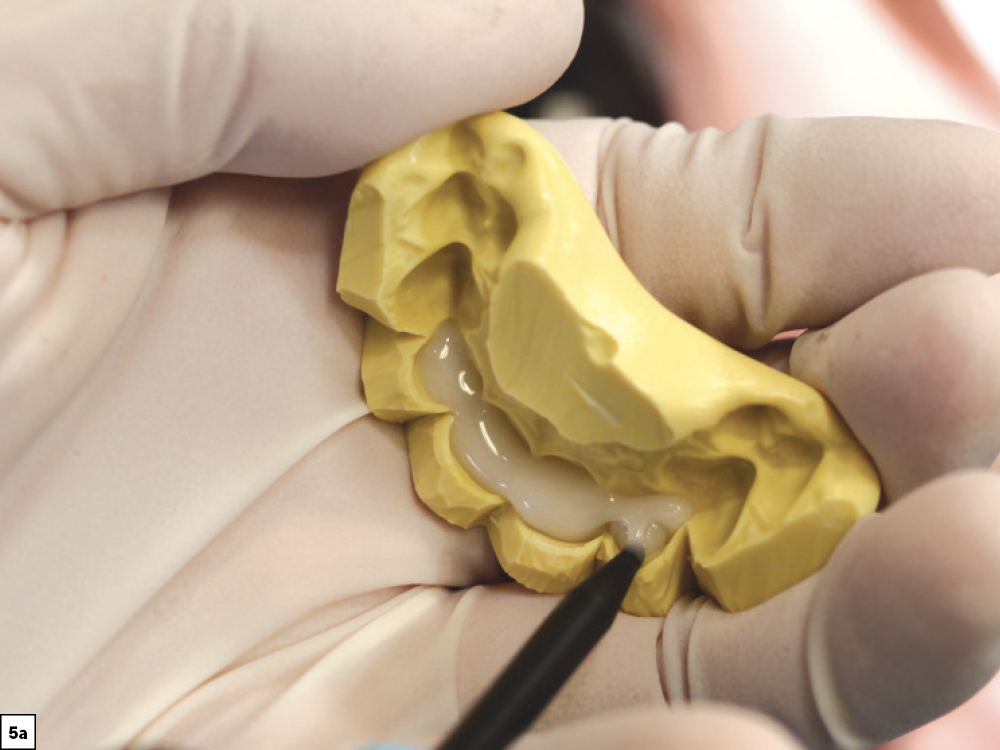 Figure 5a - Using a Diagnostic Wax-Up to Achieve Optimal Esthetics