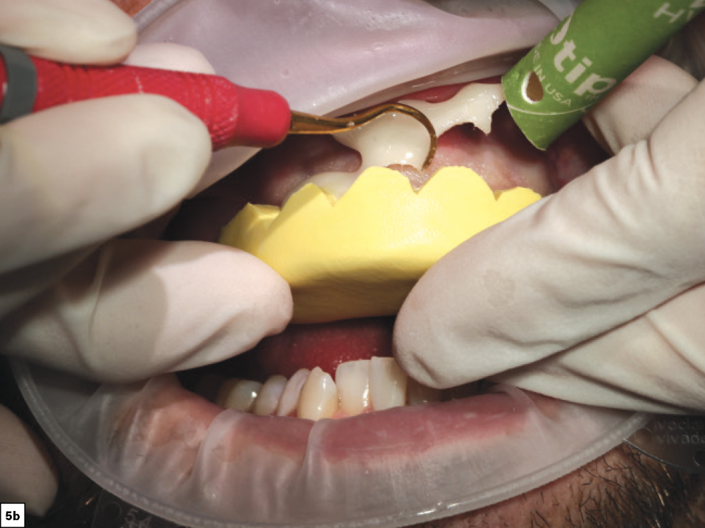 Figure 5b - Using a Diagnostic Wax-Up to Achieve Optimal Esthetics