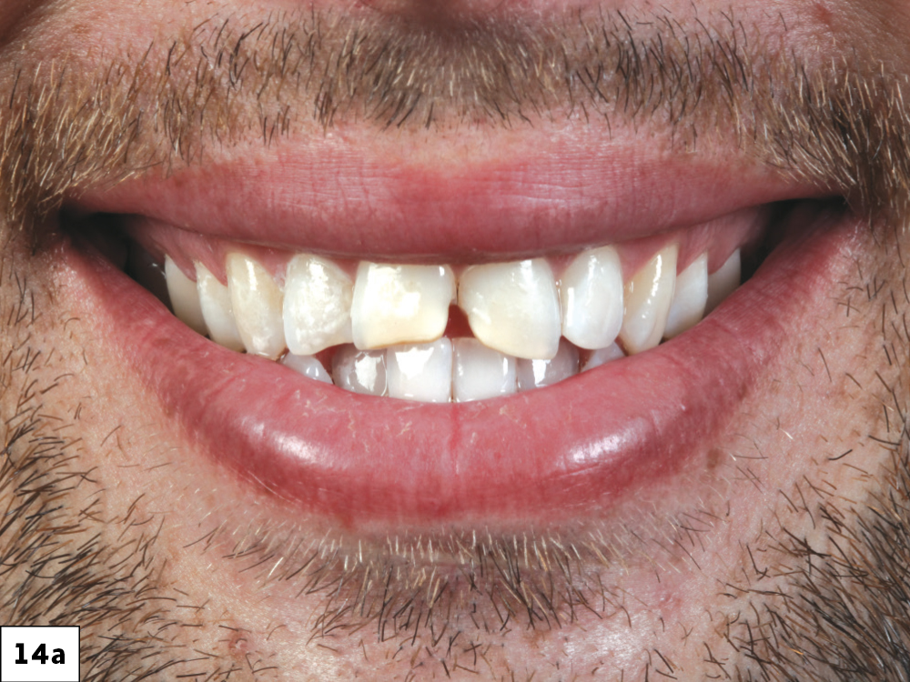 Figure 14a - Using a Diagnostic Wax-Up to Achieve Optimal Esthetics