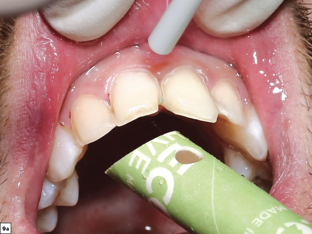 Figure 9a - Using a Diagnostic Wax-Up to Achieve Optimal Esthetics