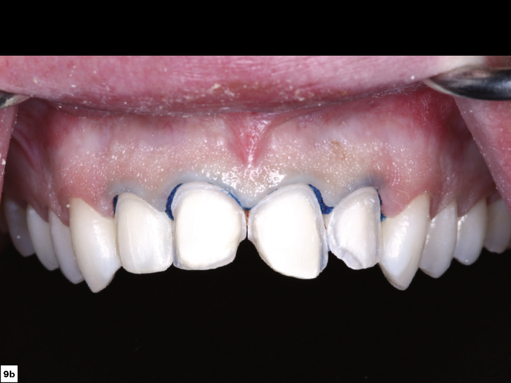 9b - Using a Diagnostic Wax-Up to Achieve Optimal Esthetics
