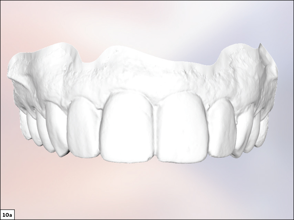 Figure 10a - Using a Diagnostic Wax-Up to Achieve Optimal Esthetics