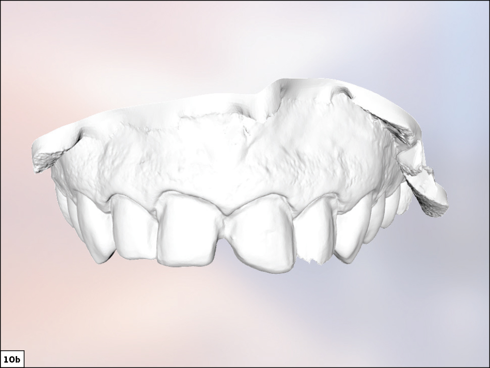 Figure 10b - Using a Diagnostic Wax-Up to Achieve Optimal Esthetics