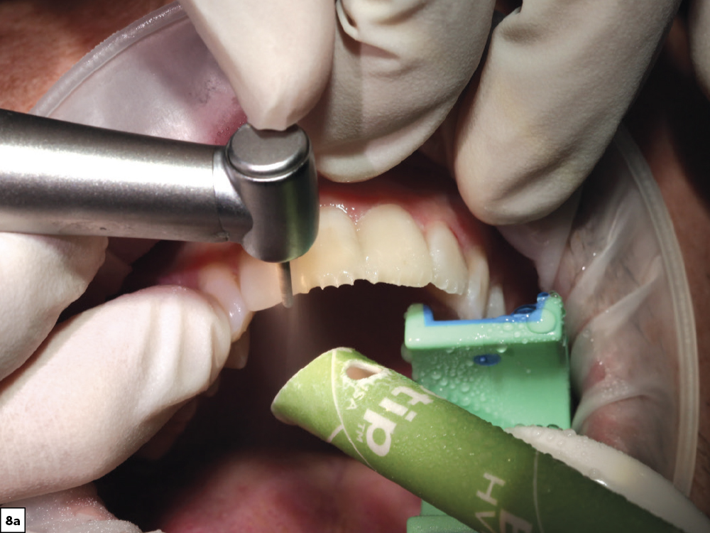 Figure 8a - Using a Diagnostic Wax-Up to Achieve Optimal Esthetics
