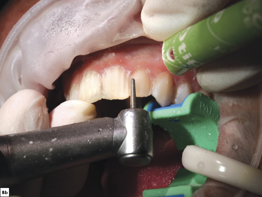 Figure 8b - Using a Diagnostic Wax-Up to Achieve Optimal Esthetics