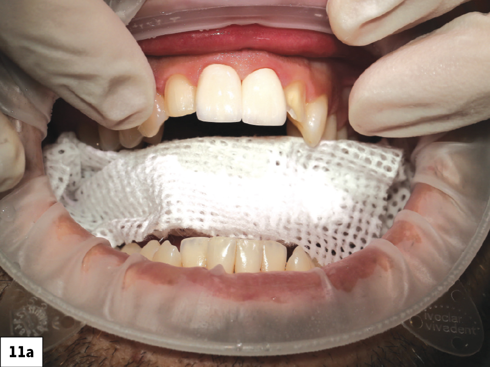 Figure 11a - Using a Diagnostic Wax-Up to Achieve Optimal Esthetics