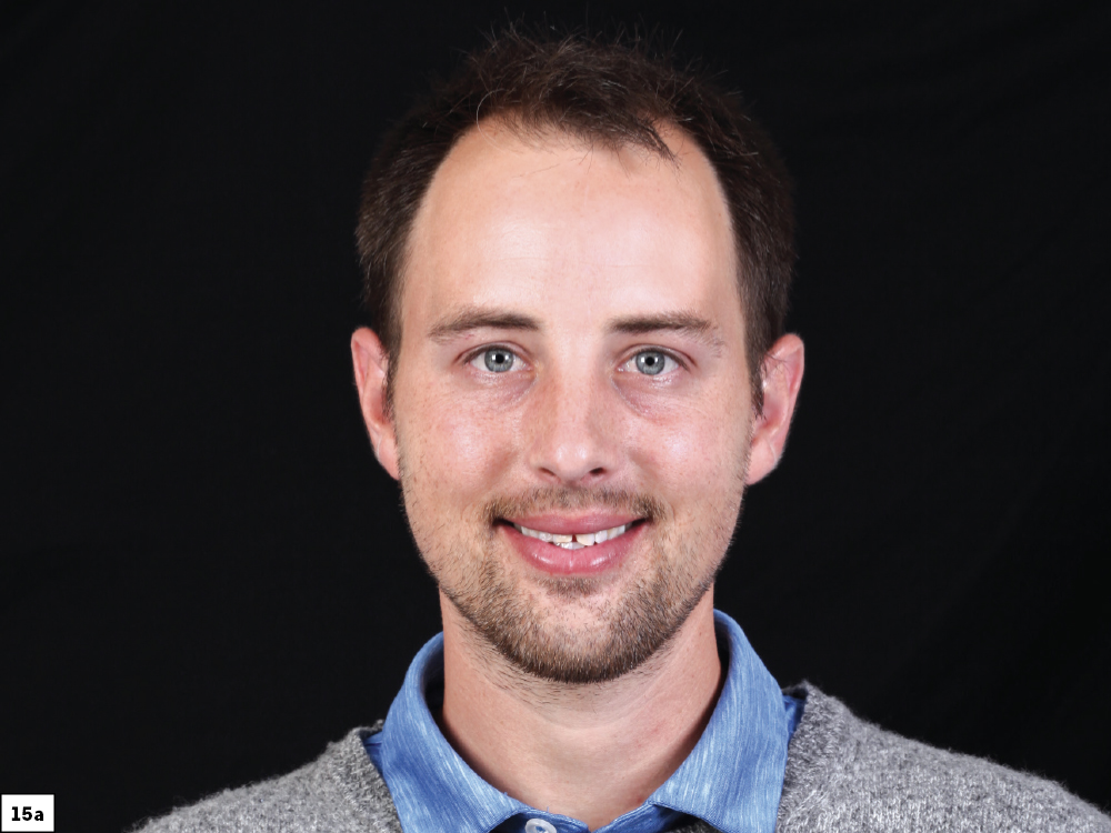 Figure 15a - Using a Diagnostic Wax-Up to Achieve Optimal Esthetics