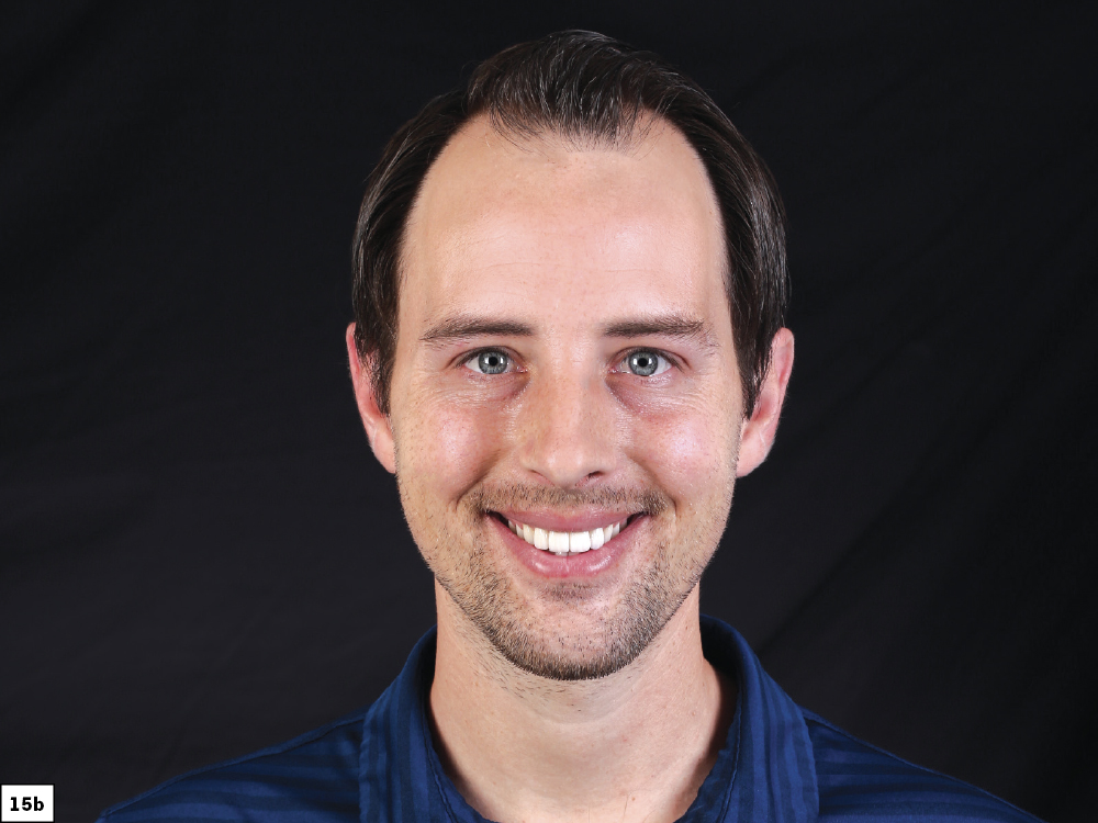 Figure 15b - Using a Diagnostic Wax-Up to Achieve Optimal Esthetics