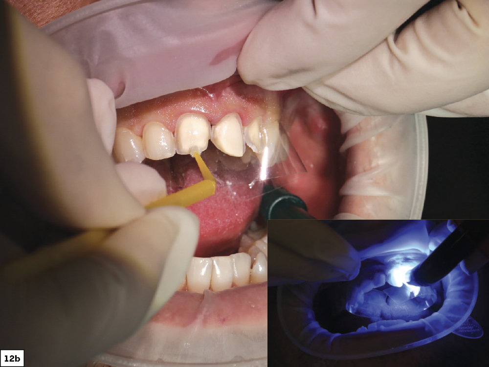 Figure 12b - Using a Diagnostic Wax-Up to Achieve Optimal Esthetics