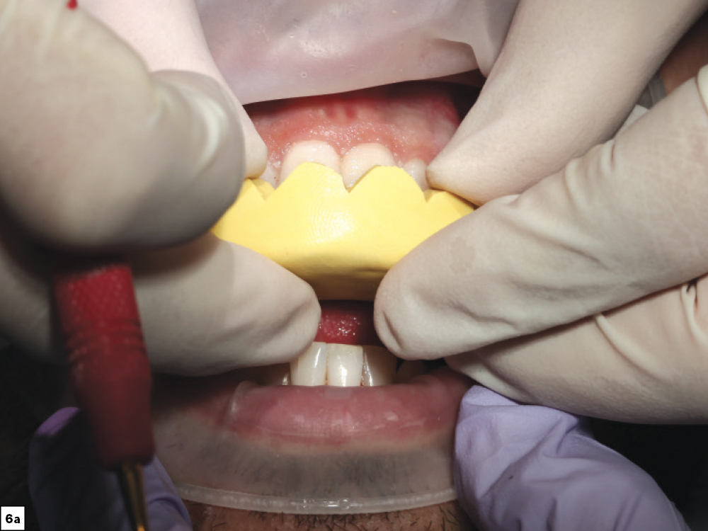 Figure 6a - Using a Diagnostic Wax-Up to Achieve Optimal Esthetics