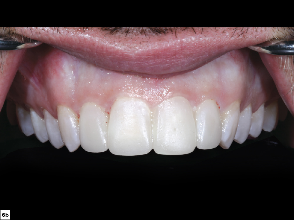 Figure 6b - Using a Diagnostic Wax-Up to Achieve Optimal Esthetics