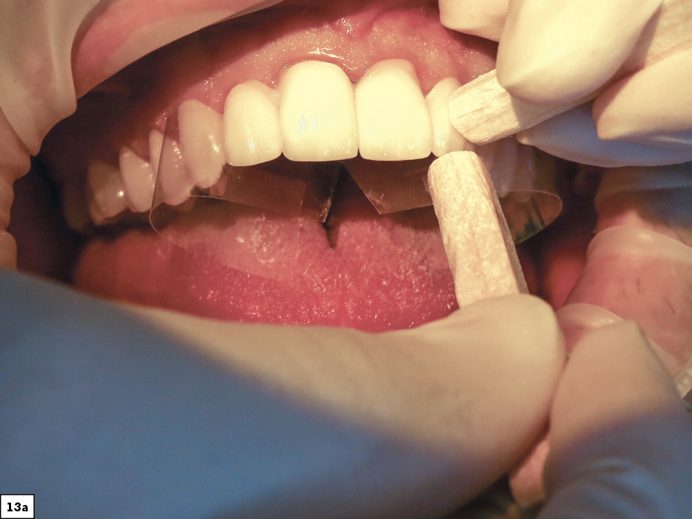 Figure 13a - Using a Diagnostic Wax-Up to Achieve Optimal Esthetics