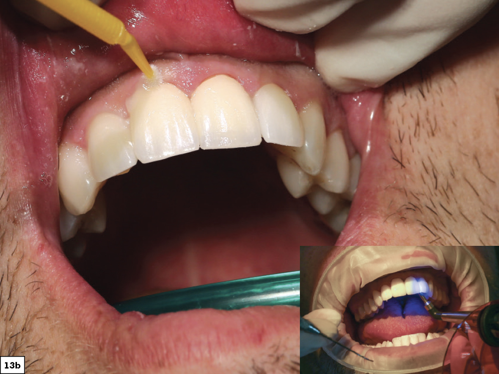 Figure 13b - Using a Diagnostic Wax-Up to Achieve Optimal Esthetics