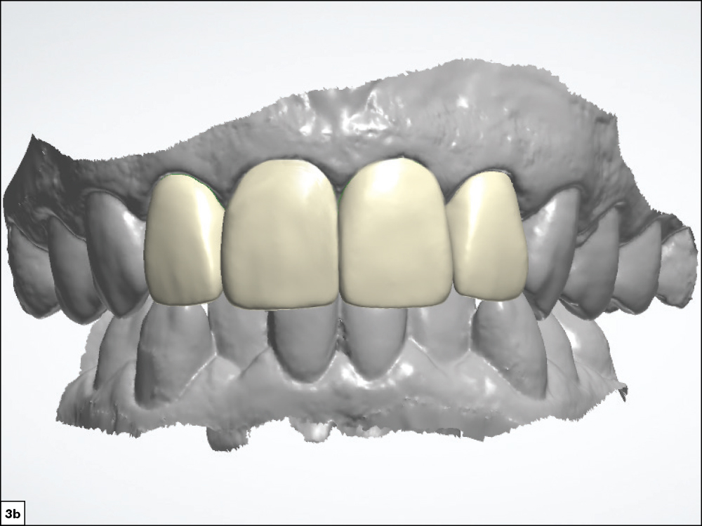 Figure 3b - Using a Diagnostic Wax-Up to Achieve Optimal Esthetics