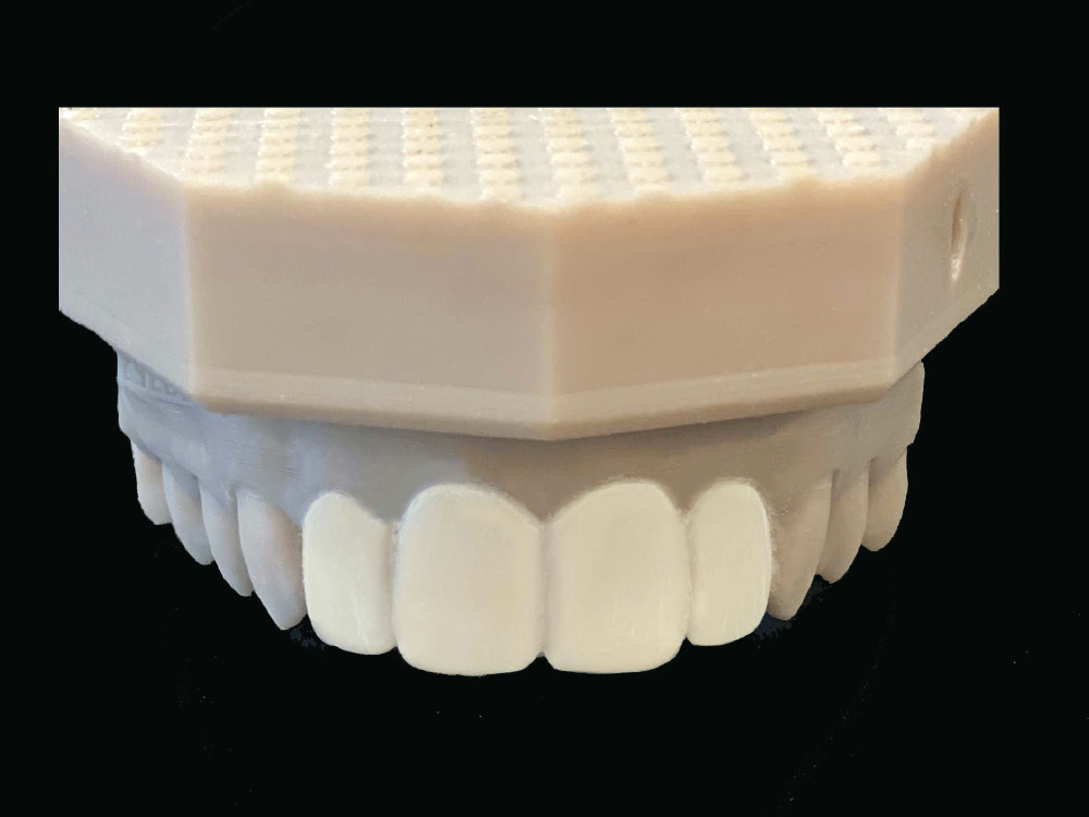 Figure 4 - Using a Diagnostic Wax-Up to Achieve Optimal Esthetics