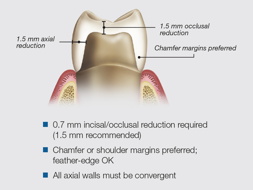 BruxZir® Esthetic NOW Posterior Milling Blocks