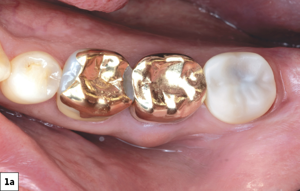 Pain in tooth #18 (Top View)