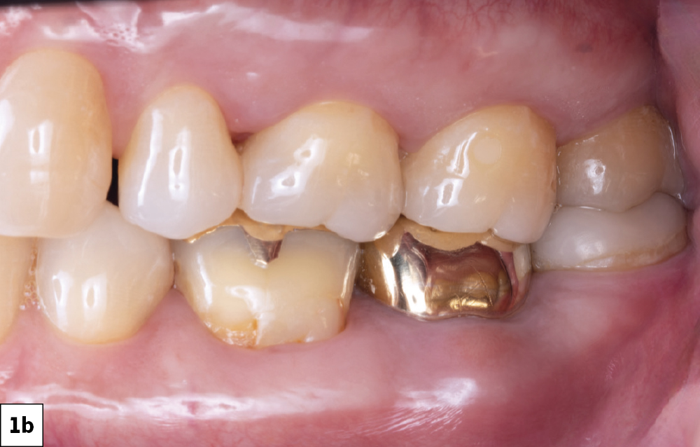 Pain in tooth #18 (Side View)