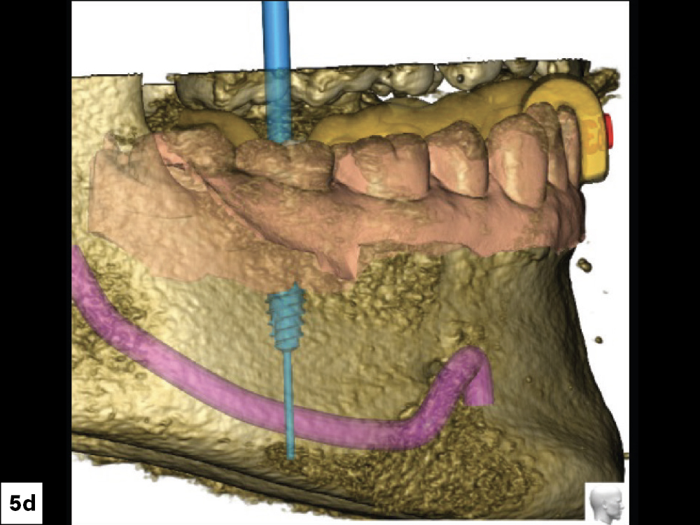 CBCT Scan (Right View)
