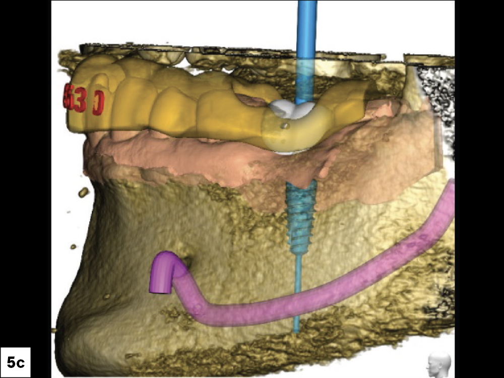 CBCT Scan (Left View)